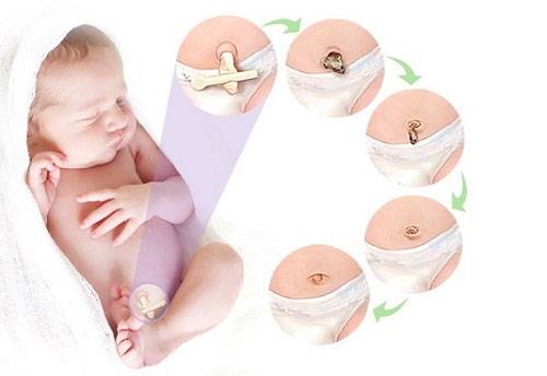 Обработка пупочной ранки у новорожденного. алгоритм в домашних условиях, роддоме, после отпадения