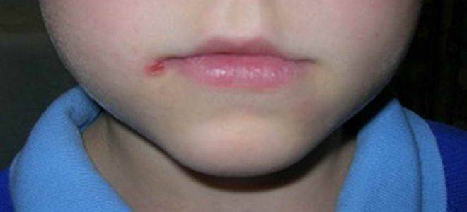 Почему возникают заеды в уголках рта у детей и как от них избавиться