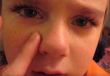 Перелом носа у ребенка: симптомы и лечение, как отличить от ушиба