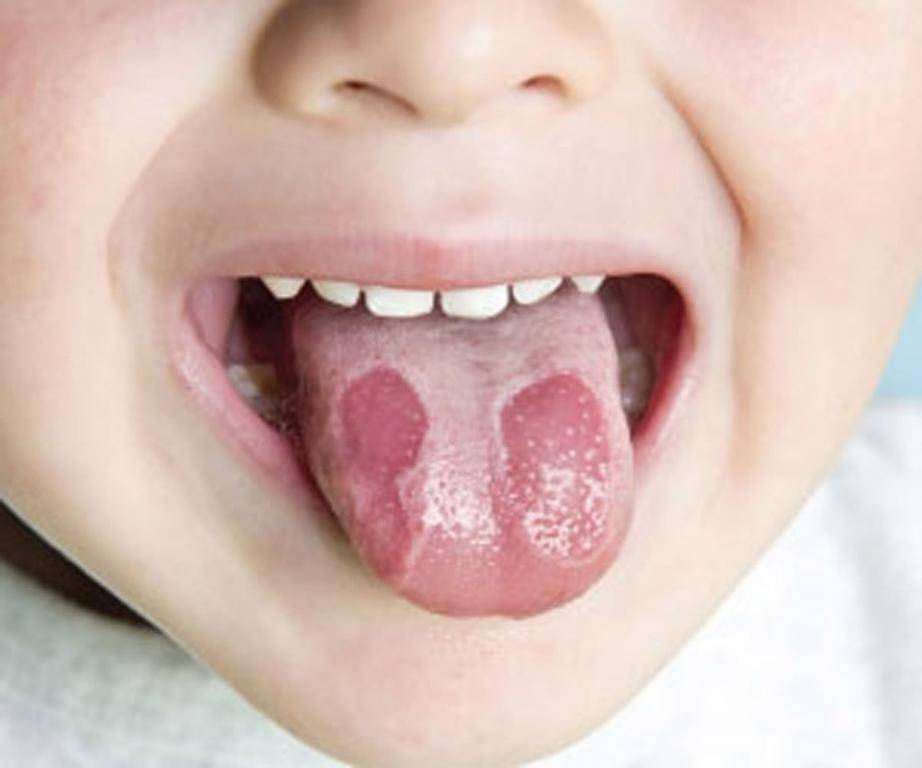 Малиновый и ярко-красный язык у взрослых и детей: причины и лечение