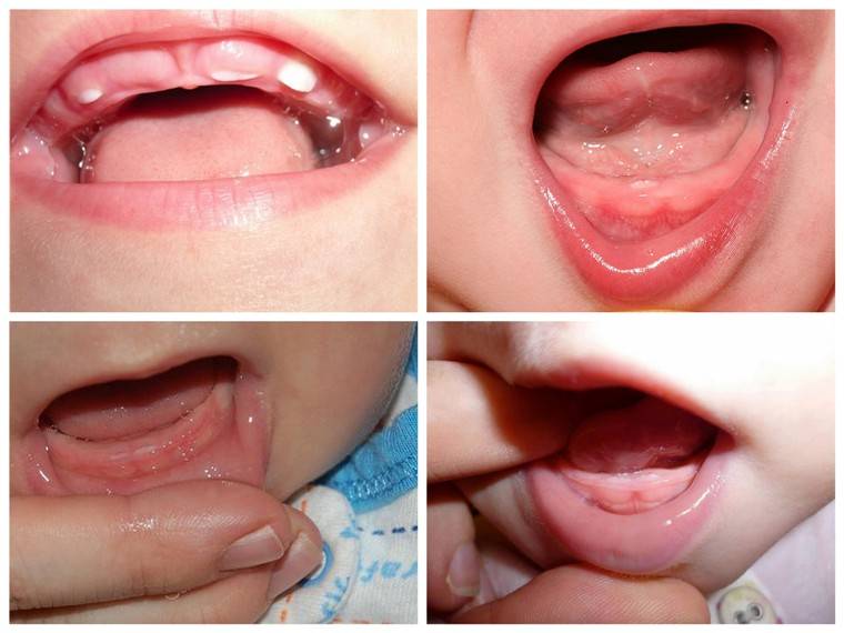 Признаки прорезывания зубов у грудничка 4 месяца и когда следует показать ребенка специалисту