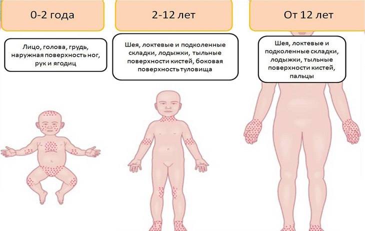 Красные прыщики на лице у новорожденного, голове, щеках, теле, в паху. причины и лечение