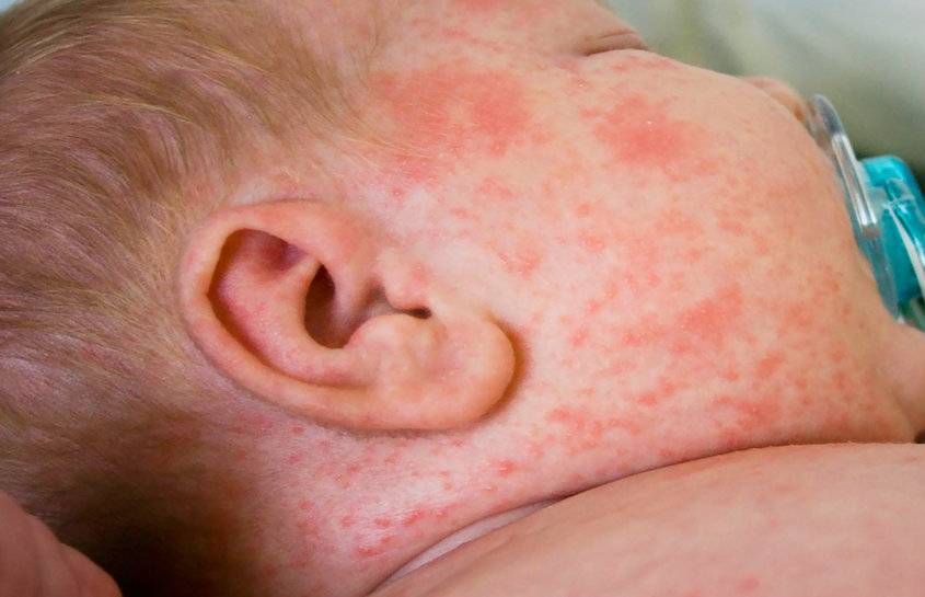 Аллергия на лице у младенца – проявление и лечение