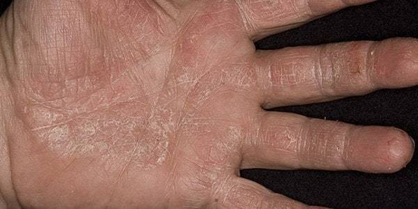 Если у ребенка облезает кожа на пальцах... - облазит кожа на пальцах рук у ребенка - запись пользователя алекс (lu0001) в сообществе детские болезни от года до трех в категории пальчики и ноготочки - babyblog.ru