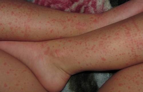 Как проявляется аллергия на шерсть животных и пыль