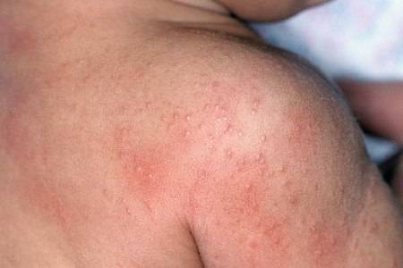 Как отличить потницу от аллергии у грудничка: фото, симптомы