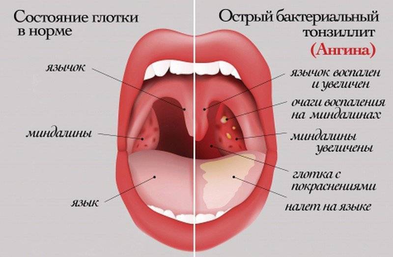 Заболевания горла и гортани, как должно выглядеть здоровое горло