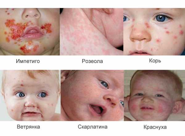 Доктор комаровский о красных щеках у ребенка