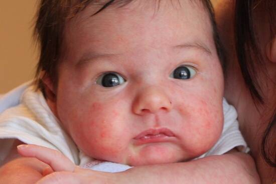 Аллергия у младенца: симптомы, причины, типы