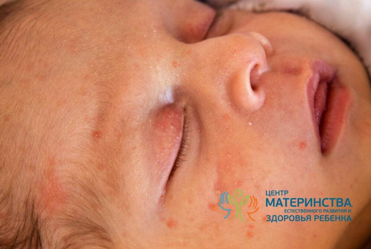 Ужасная сыпь на лице и коже головы!! - красная сыпь на лице у месячного ребенка - запись пользователя гулька (in-goolya) в сообществе здоровье новорожденных в категории высыпания на коже - babyblog.ru