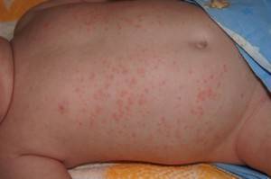 Сыпь на теле у ребенка без температуры без зуда: на животе и спине, на ногах