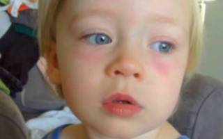 Синяки под глазами у ребенка: причины и лечение. как избавиться в домашних условиях. какие анализы сдать