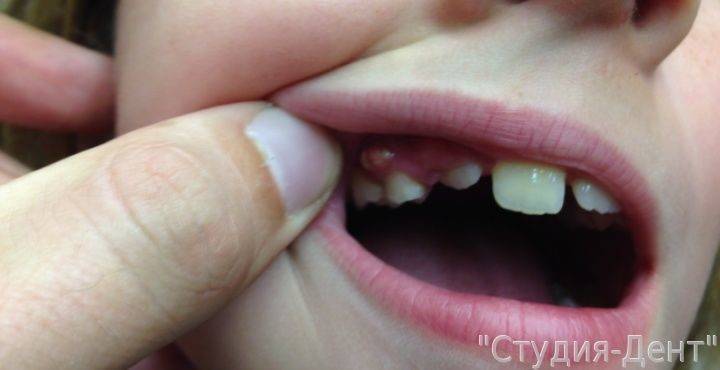 Поздние зубы у ребенка, причины задержки и виды отклонений