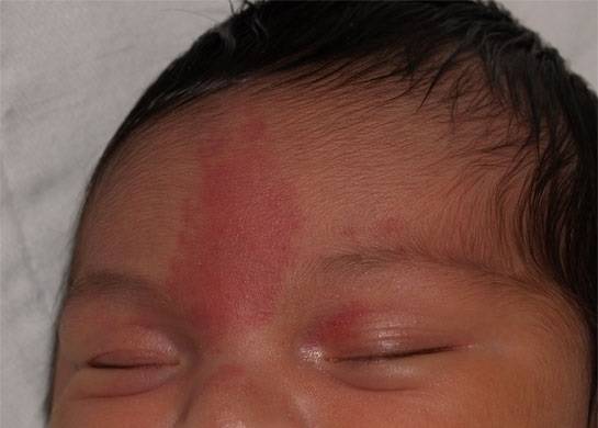 Красные пятна на лице у новорожденного: высыпания на коже головы