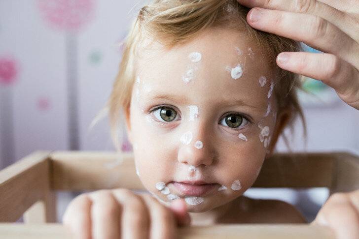 Советы мамам: что делать, если у ребенка шелушится кожа на голове?