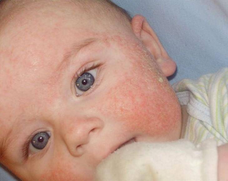 Гусиная кожа у ребенка: причины (26 фото): гусиная кожа на животе, ногах, локтях, руках - лечение грудничков