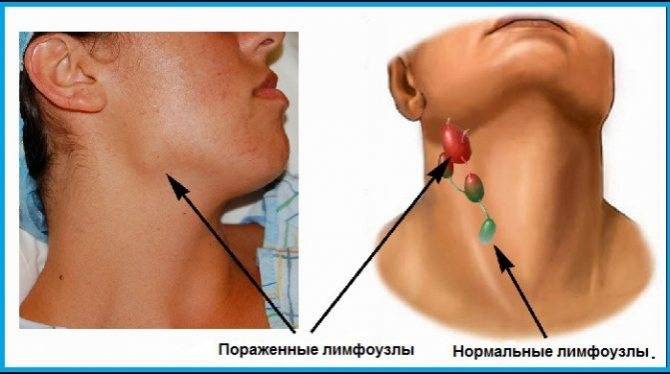 Воспаление лимфоузлов на шее у ребенка: симптомы, что делать