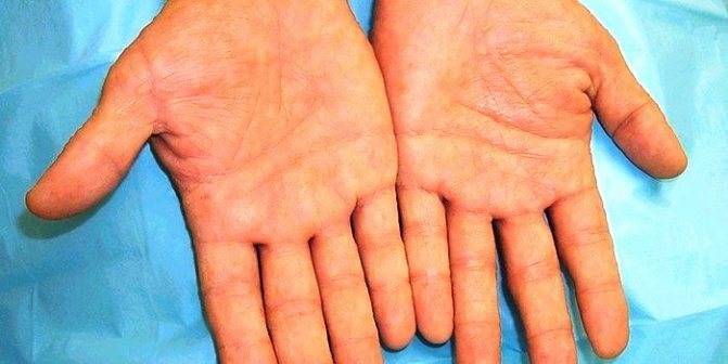 Аллергия на ладонях и ступнях взрослых. как проявляется сыпь на ладонях, кистях рук и стопах у ребенка