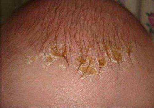 Советы мамам: что делать, если у ребенка шелушится кожа на голове?