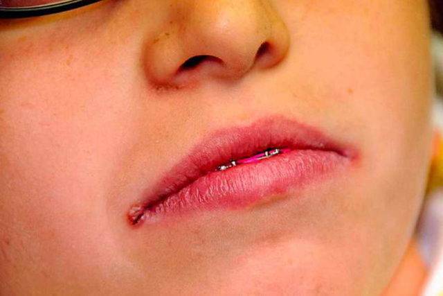 Причины появления заед в уголках рта у детей и как их лечить