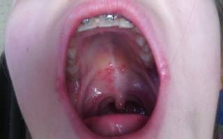 Причины возникновения красной сыпи на небе, в горле и на слизистой оболочке полости рта у взрослых и детей
