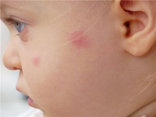 Аллергия у грудничка: причины и последствия