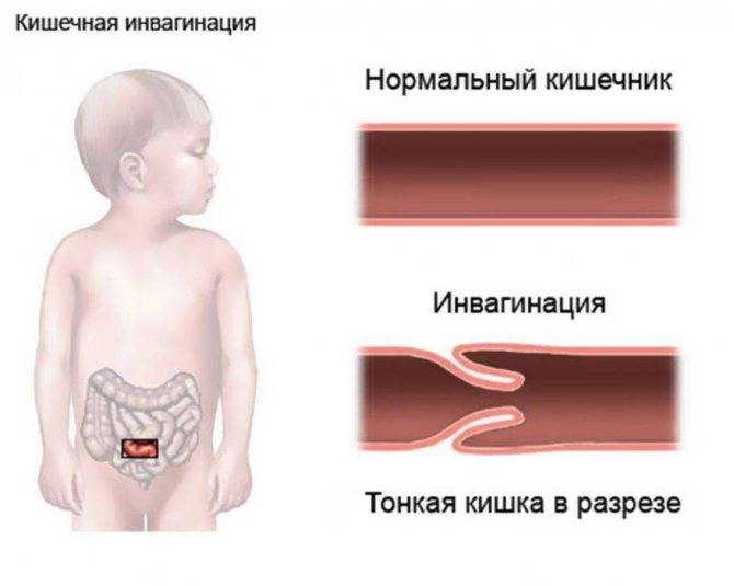 Непроходимость кишечника у детей: опасно ли это?