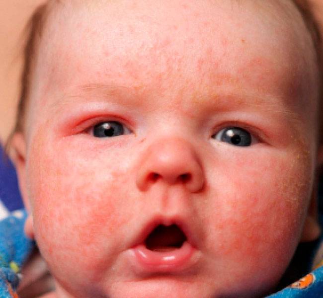 Бывает ли аллергия на грудное молоко у ребенка при грудном вскармливании