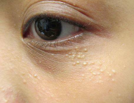 Покраснение вокруг глаз причины и лечение у ребенка