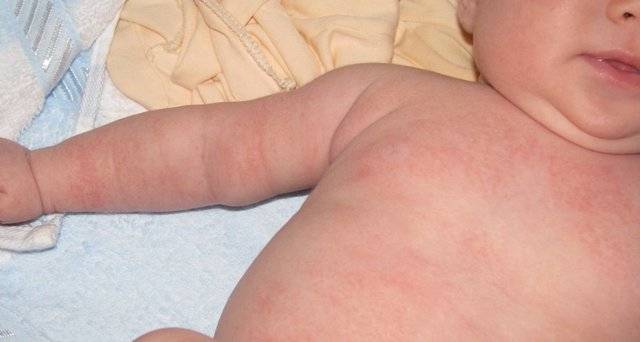 Что делать, если появилась сыпь у новорожденного или грудничка?