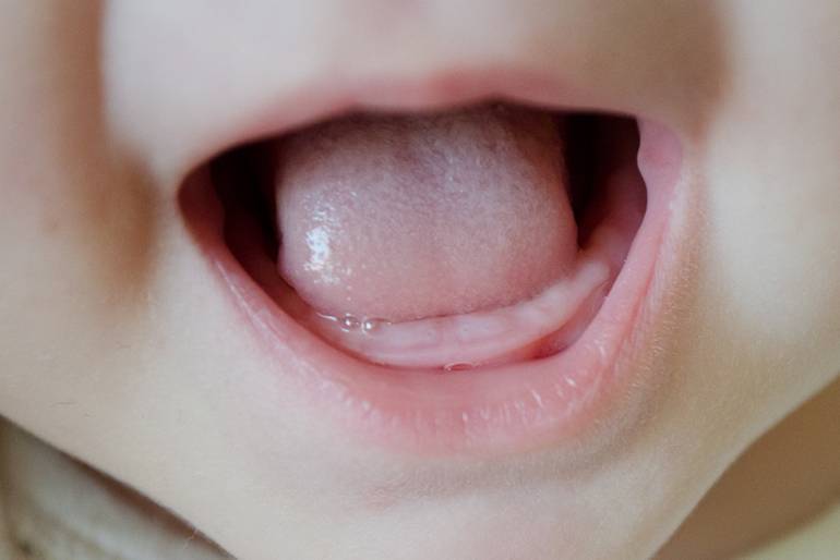 У ребенка лезут клыки: симптомы – режутся клыки самые болезненные