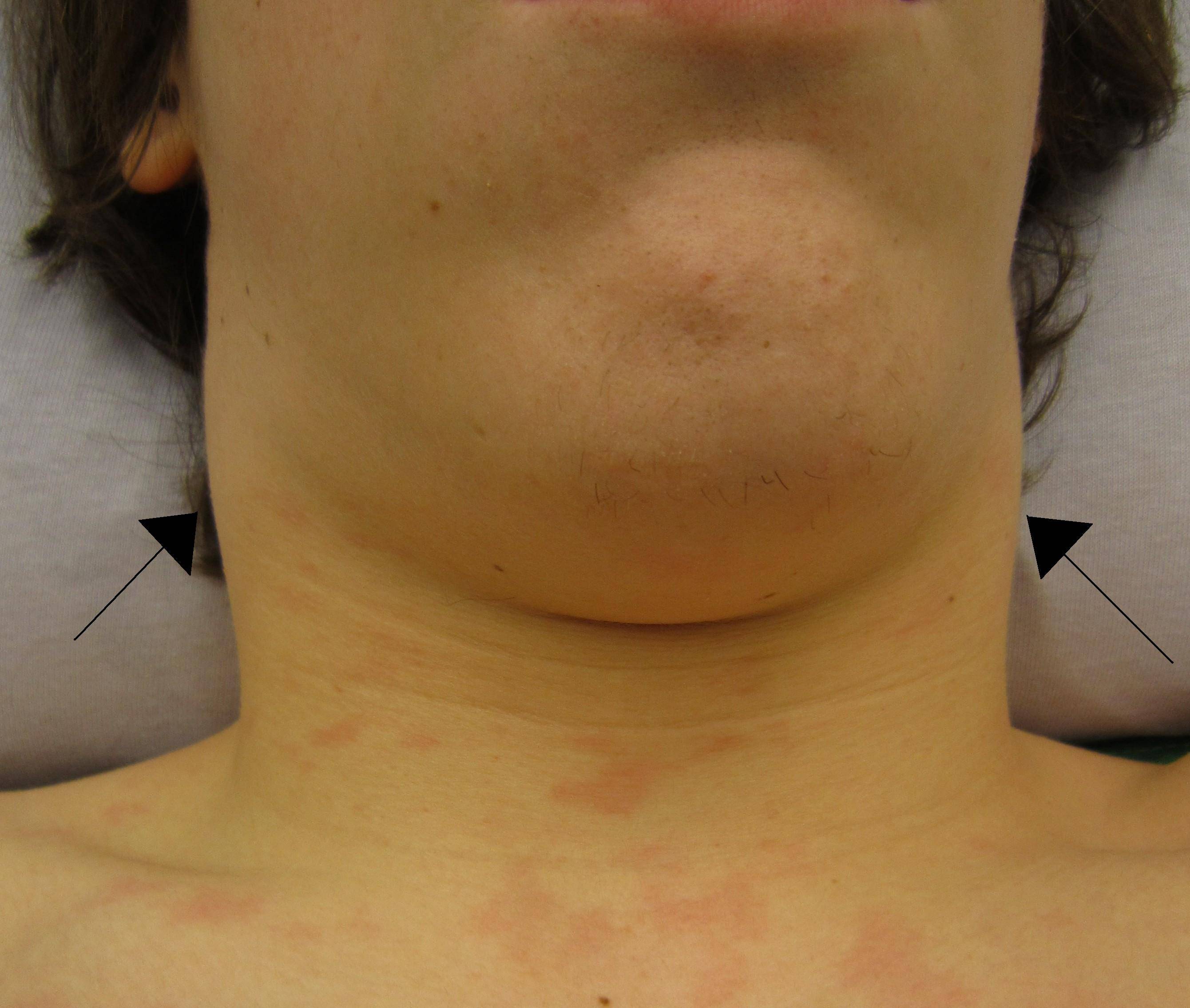 Что делать, если у ребенка на шее увеличены лимфоузлы: причины воспаления, симптомы и методы лечения