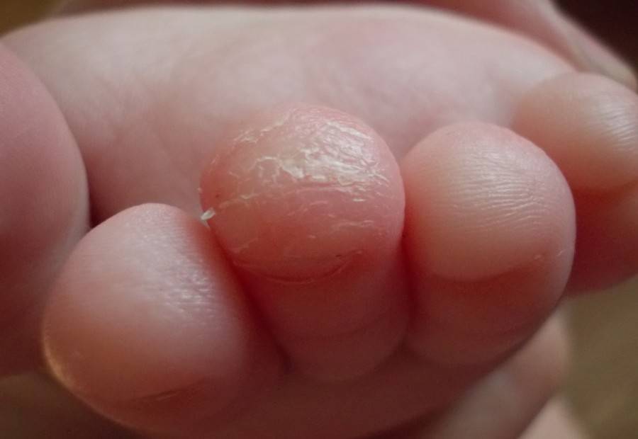 Почему между пальцами ног и рук у ребенка облазит кожа? причины и пути борьбы с заболеванием