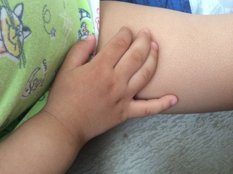 Гусиная кожа у ребенка: причины (26 фото): гусиная кожа на животе, ногах, локтях, руках - лечение грудничков