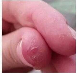 Почему облазит кожа у ребенка? облазит кожа на пальцах: что делать?