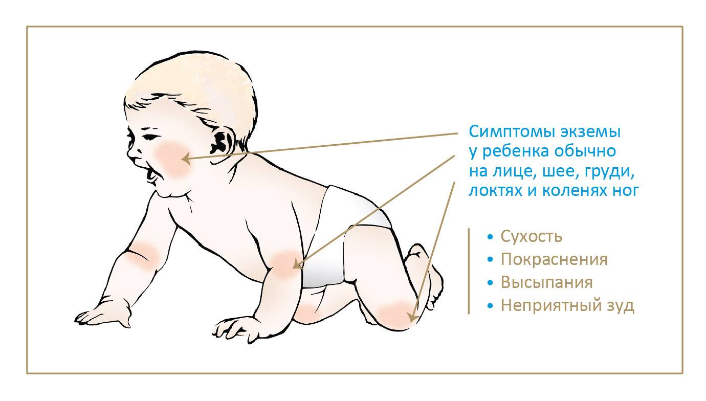 Аллергия на белок коровьего молока (еще одна хорошая статья) - аллергия на белок коровьего молока - запись пользователя мамоля (id2023237) в сообществе здоровье новорожденных в категории аллергия - babyblog.ru