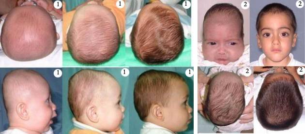 Vstala-na-kostyli - запись пользователя miki (mikilena25) в сообществе здоровье будущей мамы и малыша в категории малыш, до и после родов - babyblog.ru