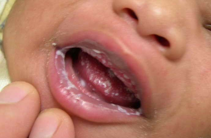 Во рту у ребенка язвочки - чем и как, лечить, обрабатывать