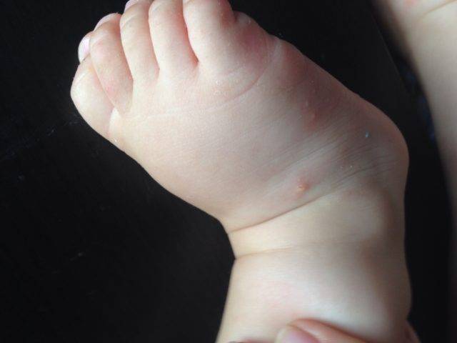 Сыпь на ногах у ребенка: этиология, причины, лечение