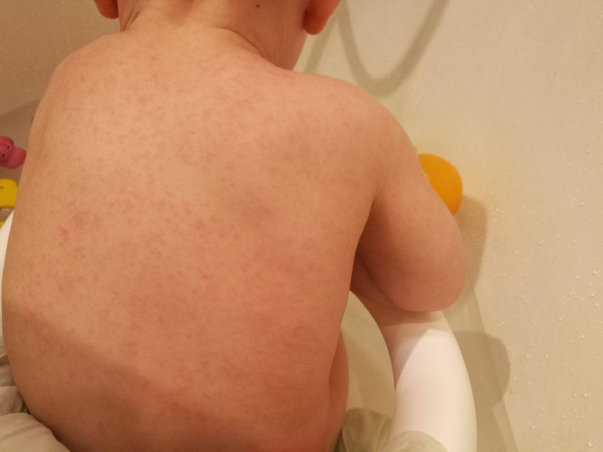 Сыпь на теле у ребенка (64 фото): причины высыпаний по всему телу с пояснениями, бесцветная сыпь после температуры