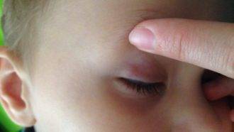 Что делать если лопнул сосуд в глазу у ребенка