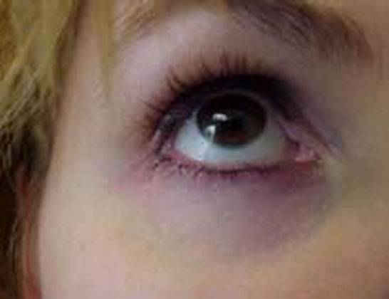 У ребенка под глазами синяки: причины, лечение, неотложные состояния, профилактика