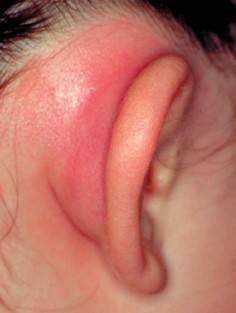 Почему при отите болит ухо и из него идет кровь у ребенка