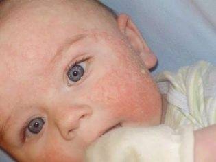 Что делать, если появилась сыпь на лице у ребенка?