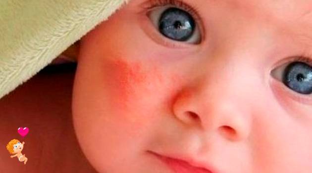 Сыпь у рта ребенка - фото, все причины и лечение