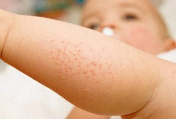 Аллергия на руках и ногах у ребенка: причины развития и лечение