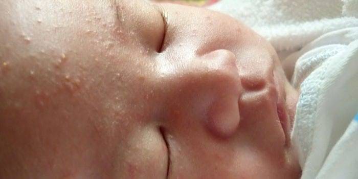 Цветение новорождённых – что это такое и как его определить