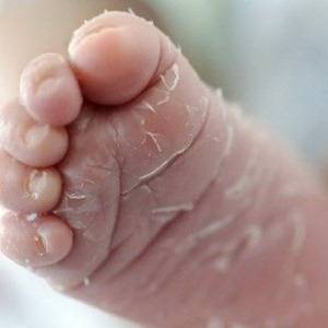 Шелушение кожи на ступнях ног у детей