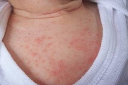 Аллергия или потница у грудничков: как отличить одно от другого