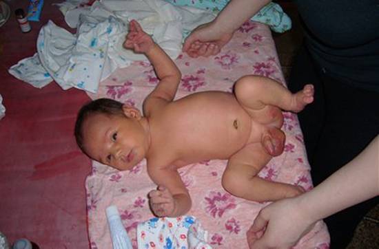 Как выглядит водянка яичка у ребенка? 16 фото - у новорожденных мальчиков и грудничков